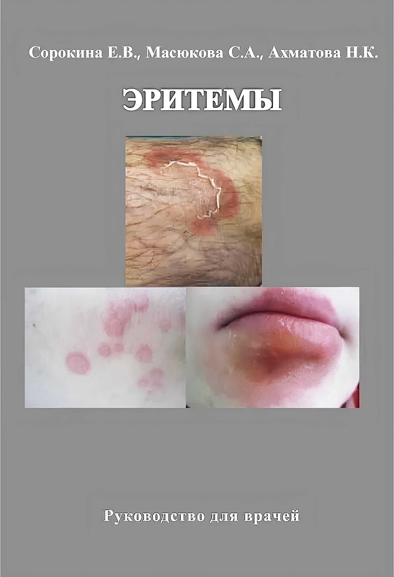 Эритемы. Руководство для врачей